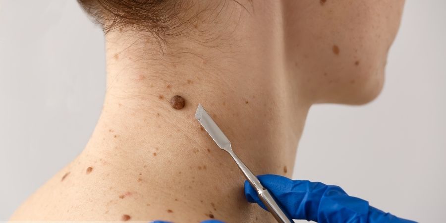 Mole Removal